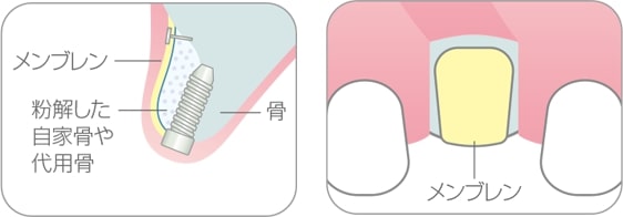 GBR（骨誘導再生法）