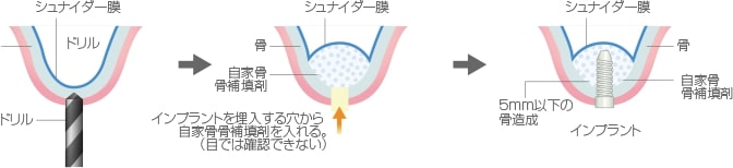 ソケットリフト