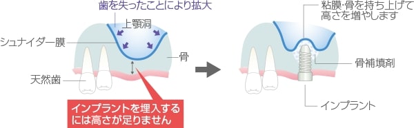 サイナスリフト